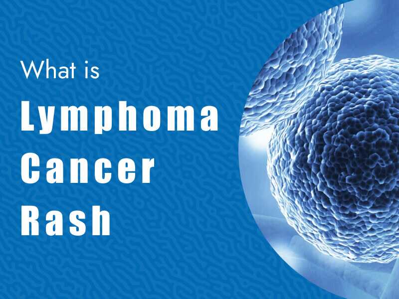 Lymphoma Rash