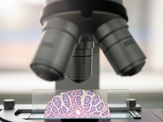 Sebaceous Epithelioma