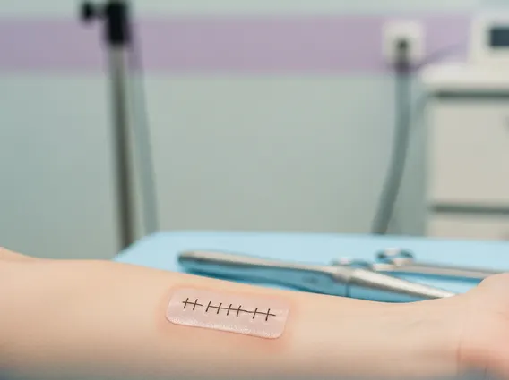 Skin Graft
