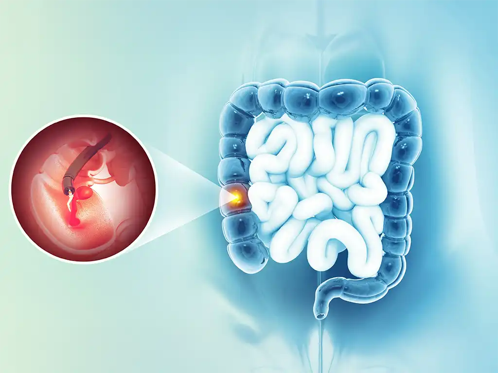 Προετοιμασία για Κολονοσκόπηση: Διατροφή, Καθαρτικά και Χρήσιμες Οδηγίες