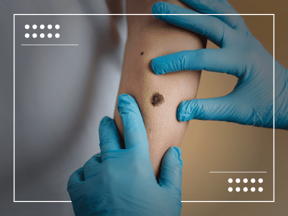 7 Signs Your Melanoma Has Spread