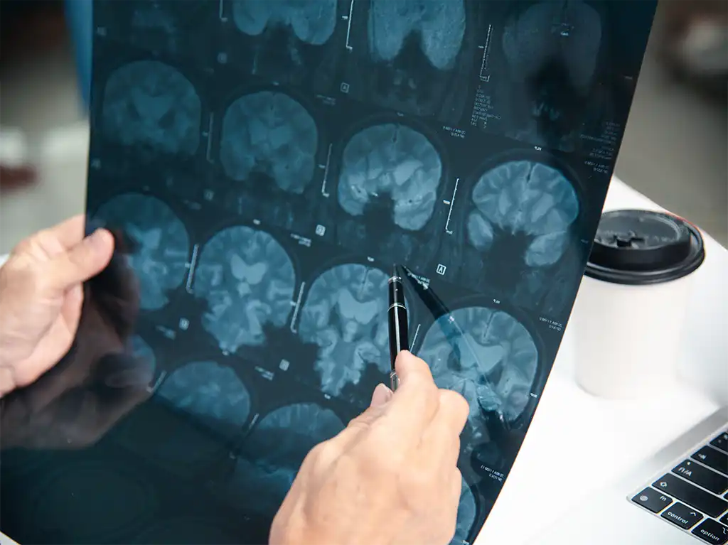 ¿Dolor de Cabeza o Tumor Cerebral? Guía Vital Para Distinguir los Síntomas