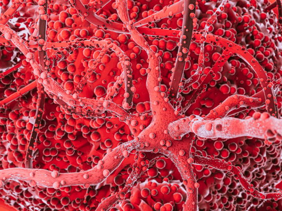 Entendiendo la Mielofibrosis: Causas, Síntomas y Diagnóstico