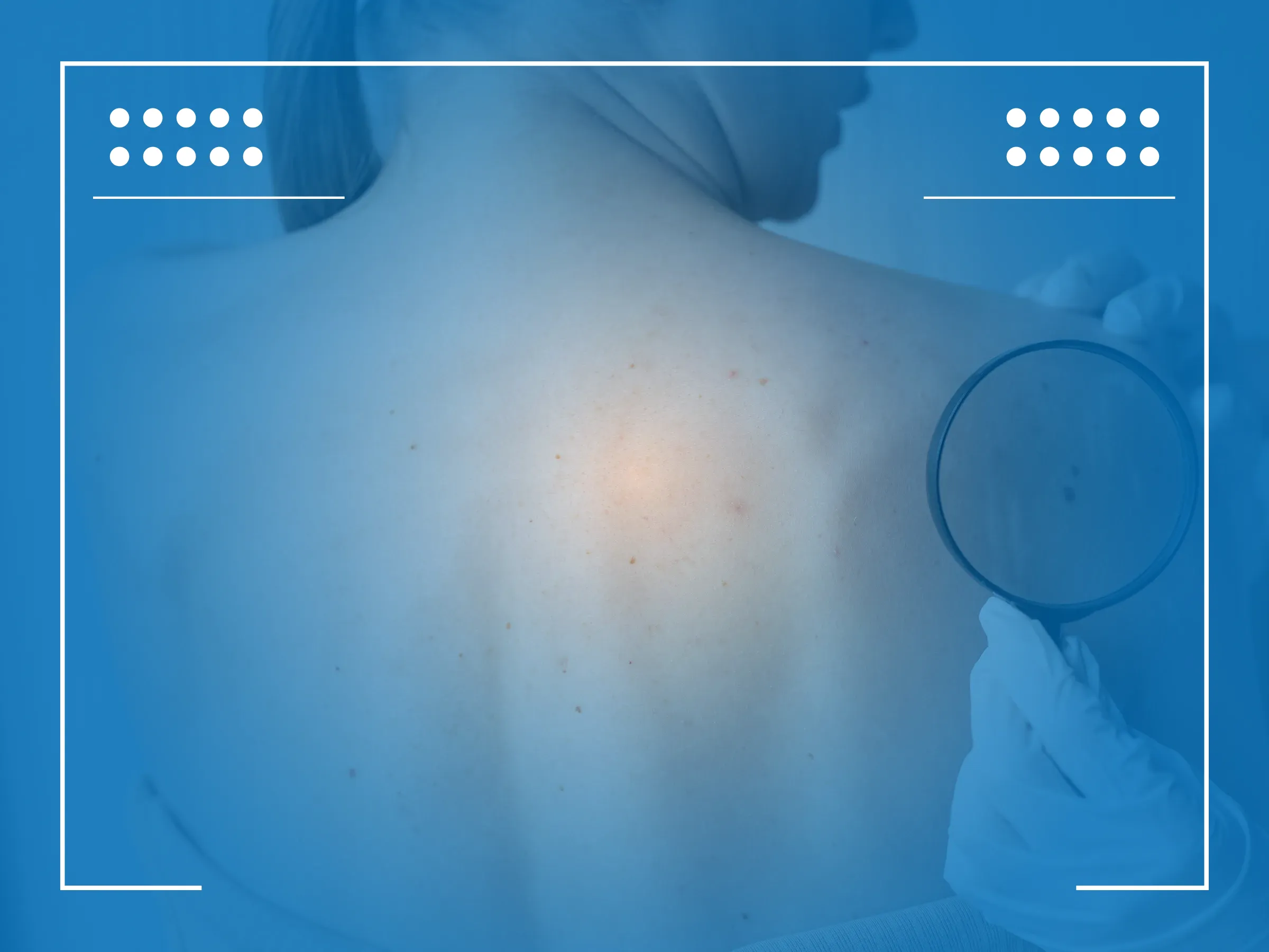 Early Stage Skin Cancer