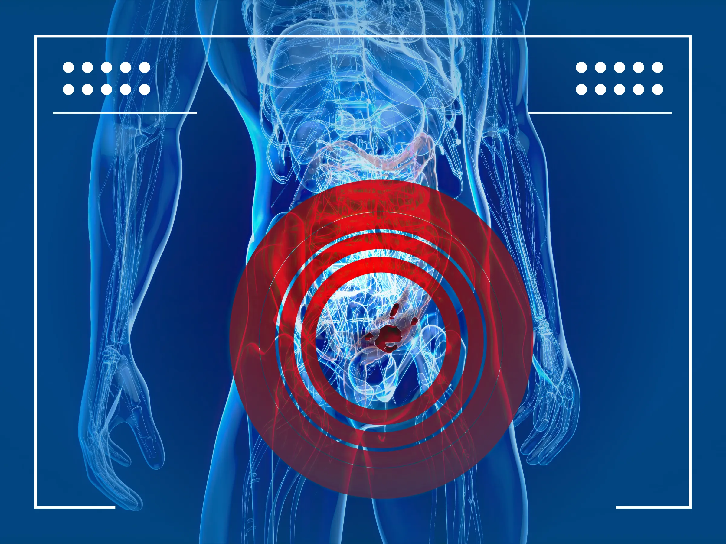 Sintomas de Câncer Colorretal