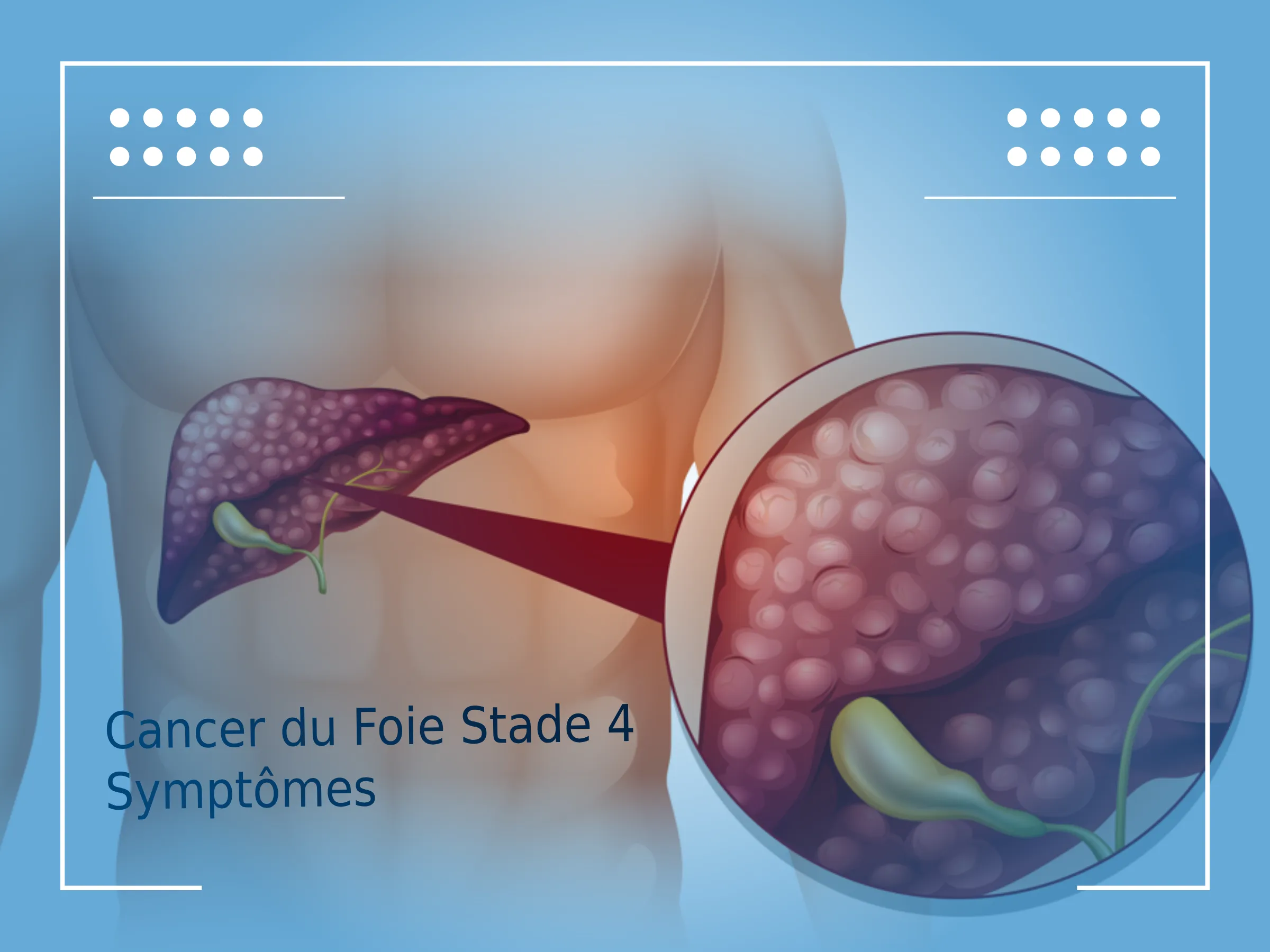 Cancer Du Foie Stade 4 Symptômes