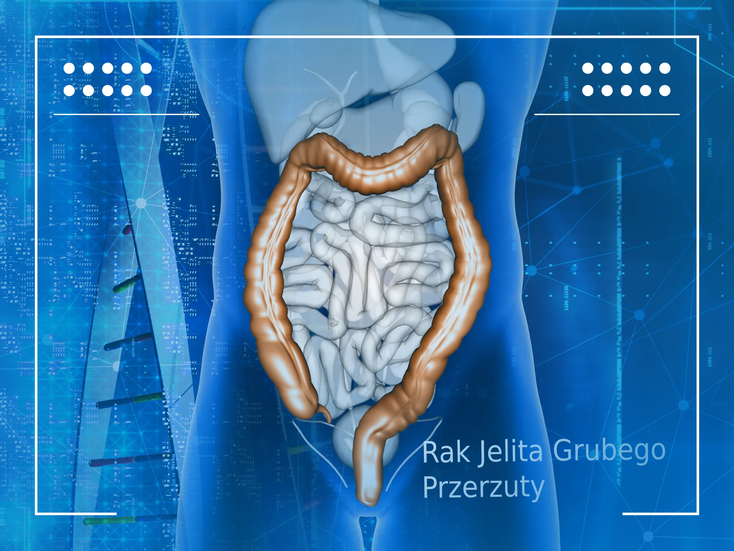 Rak Jelita Grubego Przerzuty