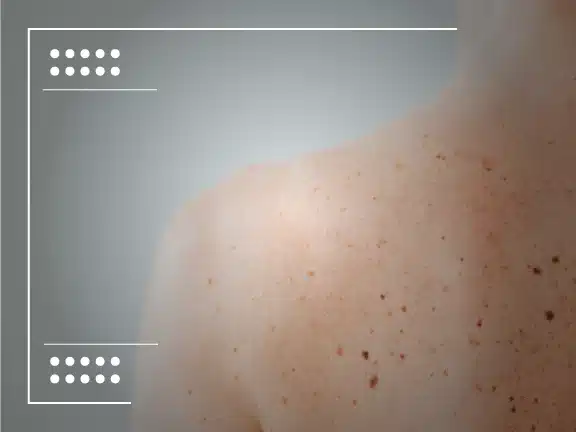 Melanoma Warning Signs