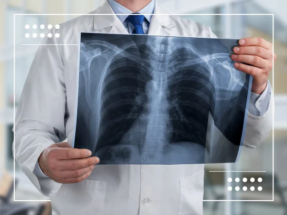 Sbloccare Nuovi Orizzonti: Esplorare gli Studi Clinici per il NSCLC Metastatico