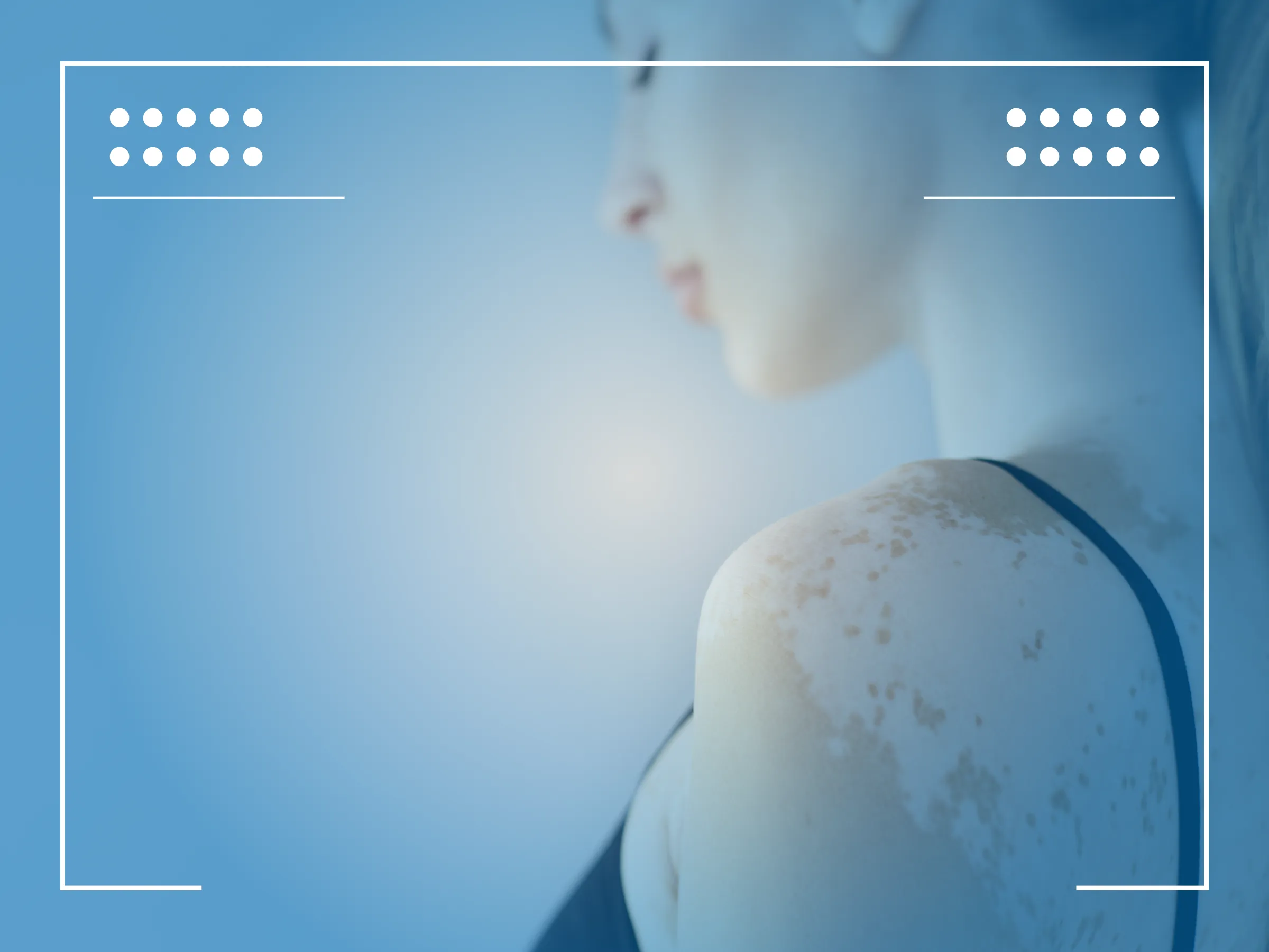 Basal cell carcinoma ICD 10