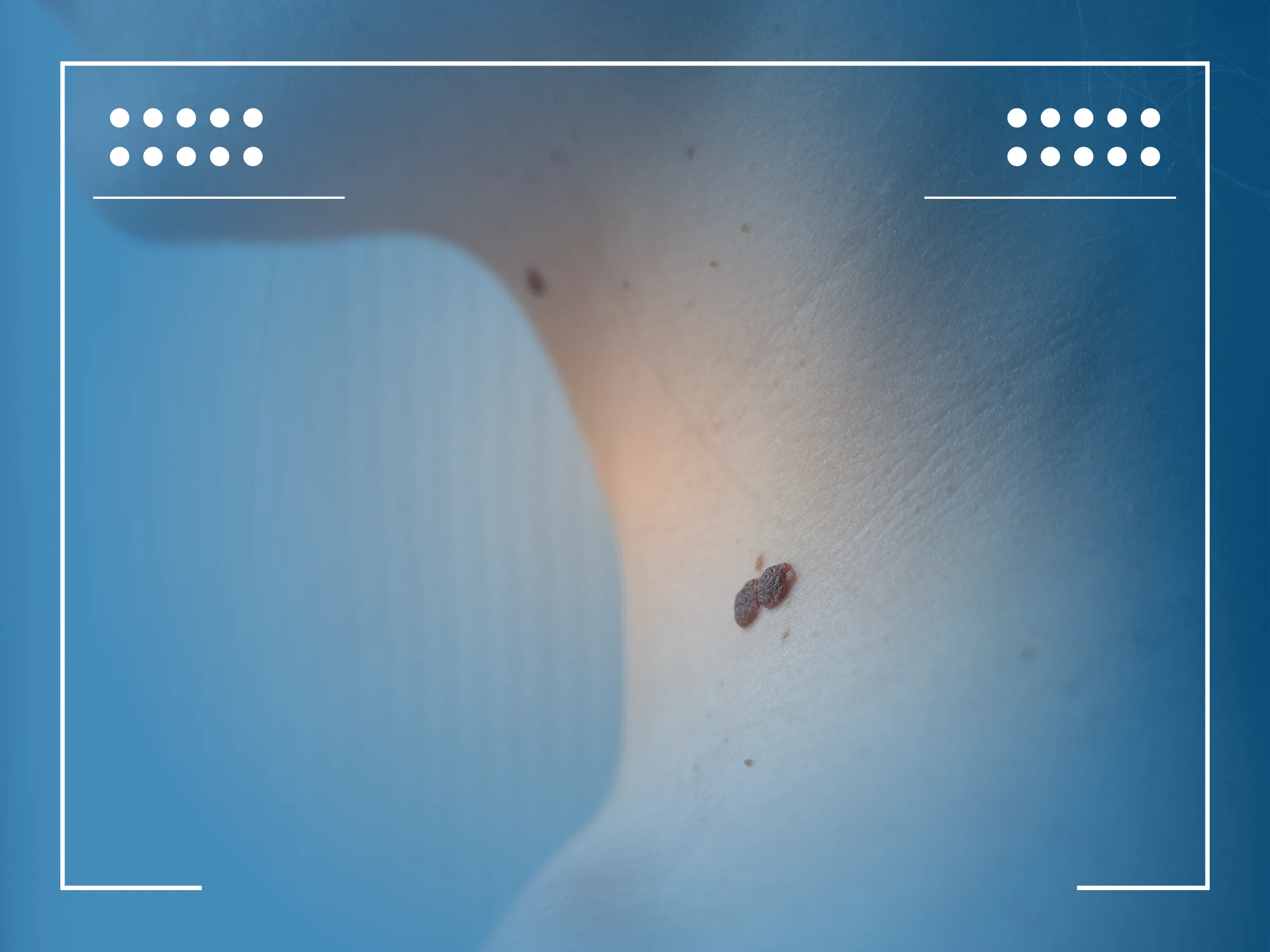 Carcinoma Basocelular Nodular