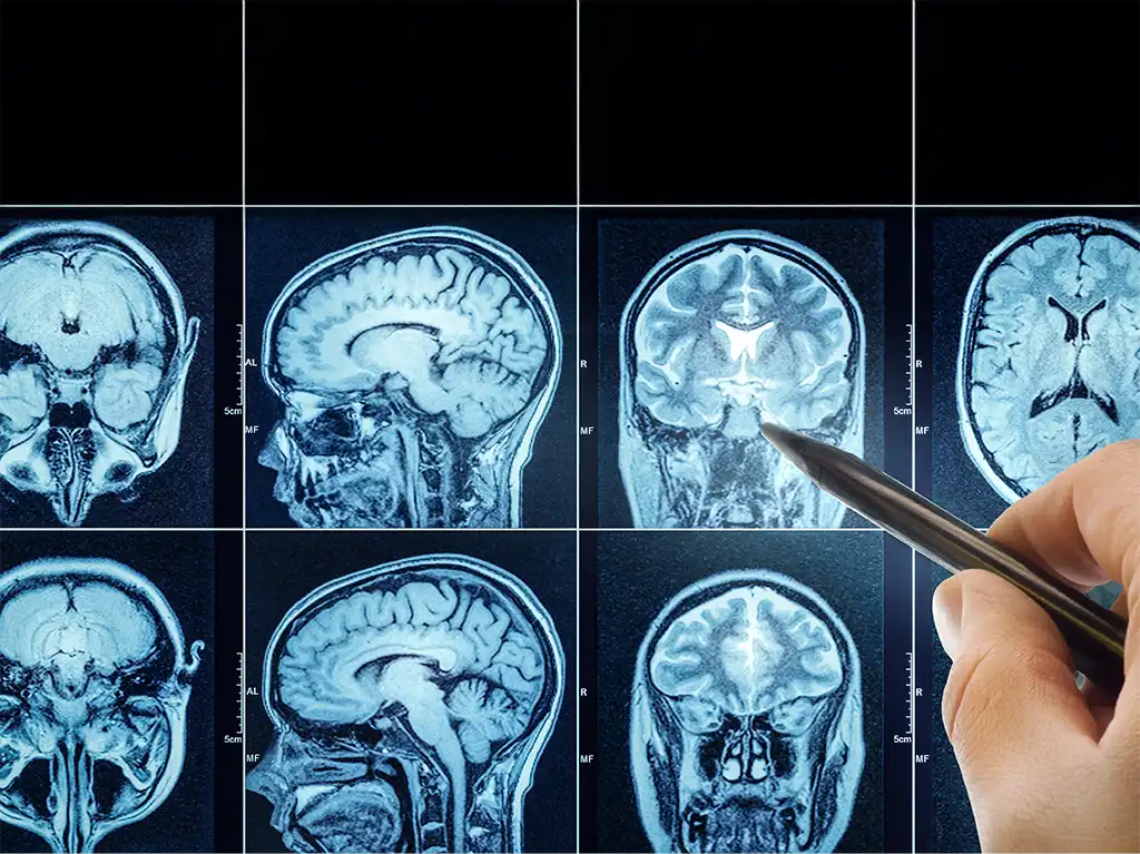 Tumeur au Cerveau : Guide Simple pour Comprendre Votre Diagnostic