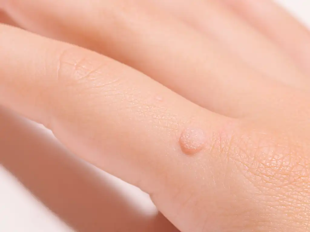 יבלת ויראלית: גורמים, תסמינים ושיטות טיפול יעילות