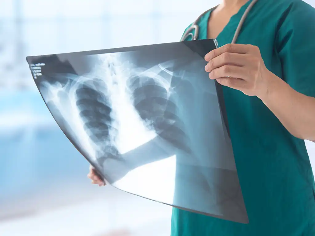 Rak Płuc: Objawy, Nietypowe Symptomy i Rozpoznanie w 4 Stadium