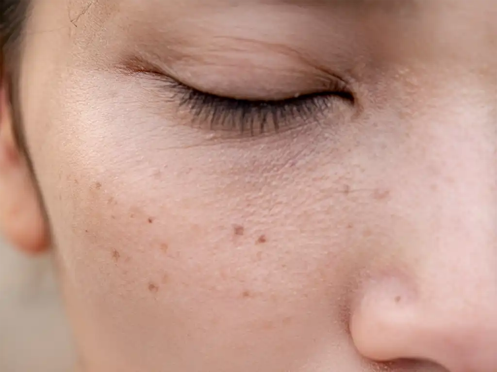 Anemia Mediterranea: Síntomas, Tratamiento y Prevención