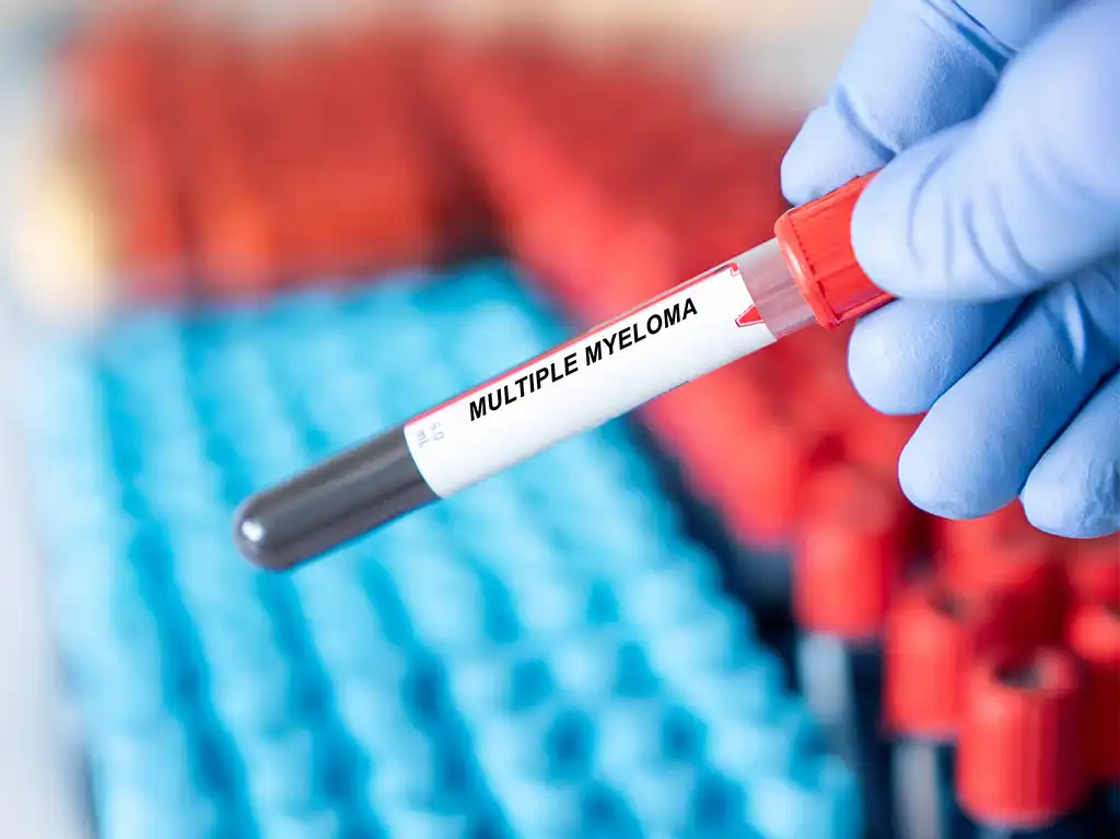 L'importanza degli esami del sangue nella diagnosi del mieloma multiplo