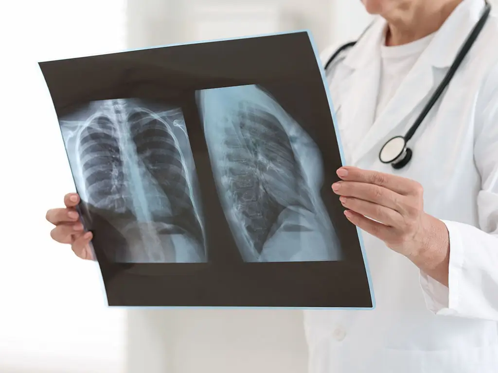 Symptômes du cancer du poumon de stade 1 : quand consulter un médecin