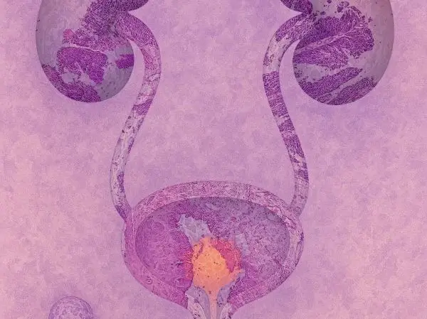Carcinoma Uroteliale: Sintomi, Stadi, Metodi di Trattamento