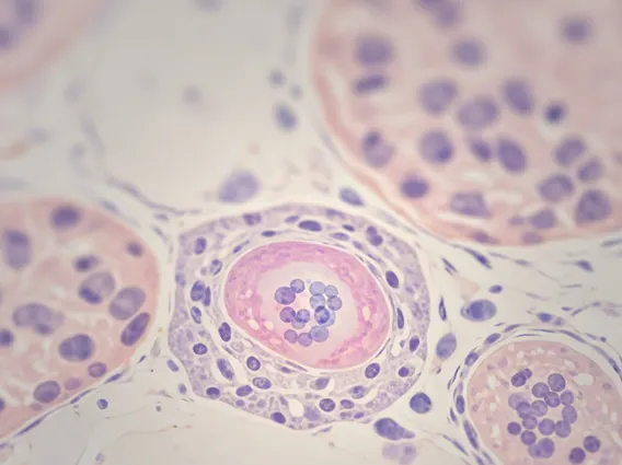 Living with Merkel Cell Carcinoma