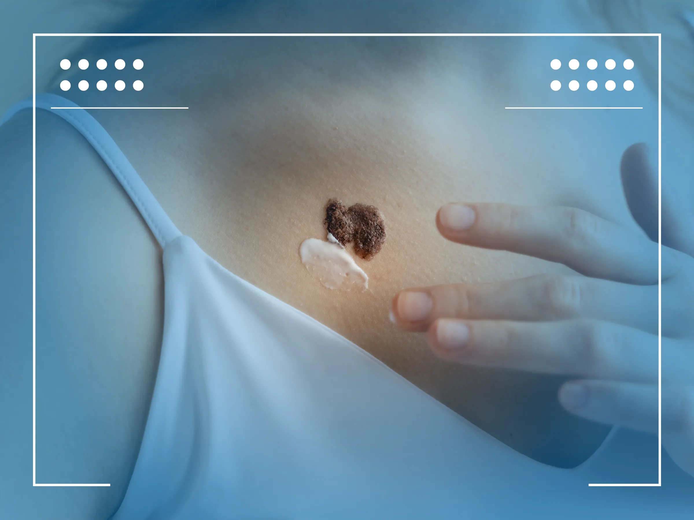 Tipos de Câncer de Pele