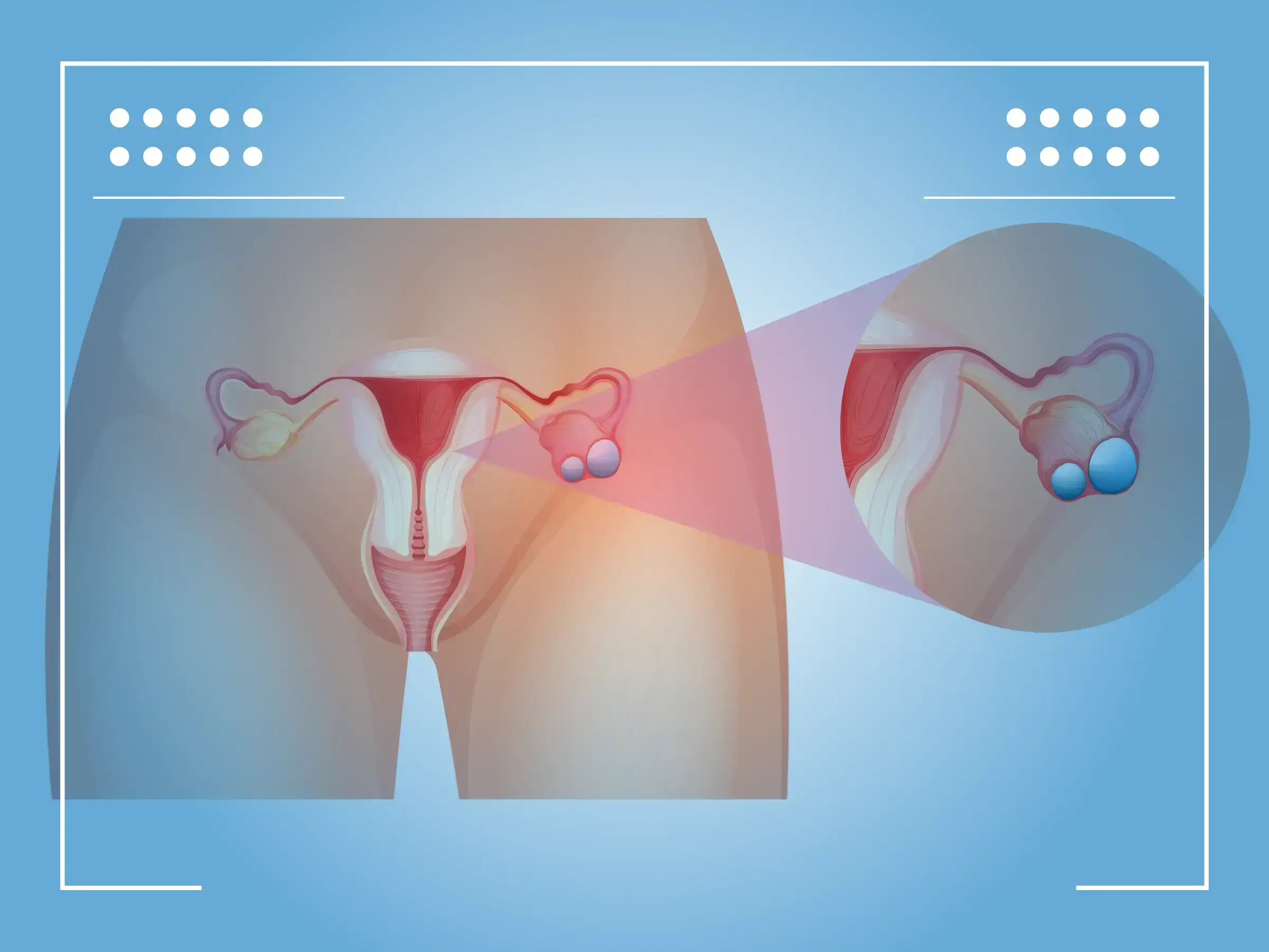 Cancer Ovaire Symptome