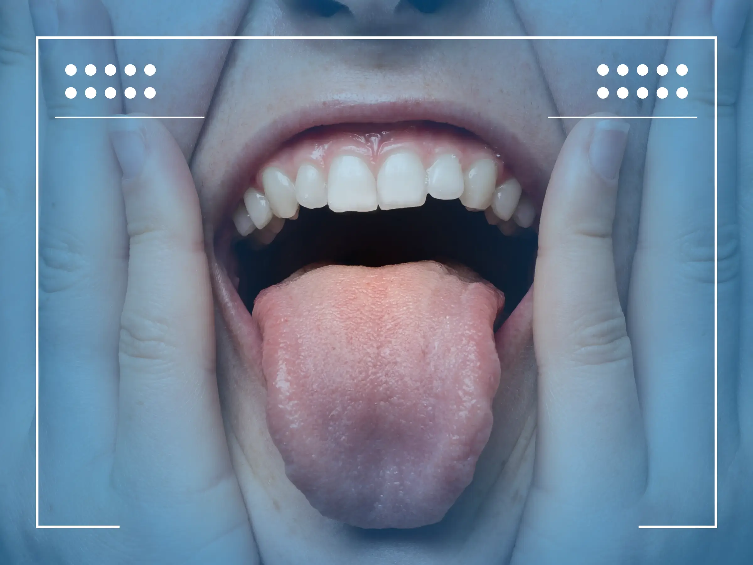 Inizio Cancro Alla Lingua