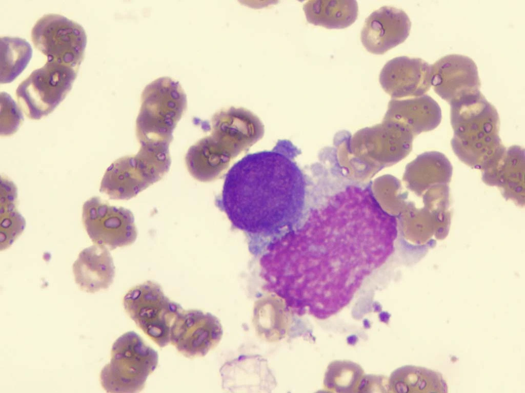 Was ist Myelofibrose