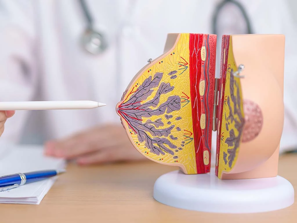 Cáncer de mama inflamatorio en etapa temprana: cómo se manifiesta