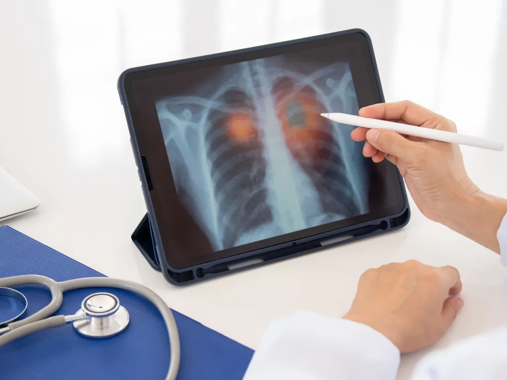 Comprender las estadísticas más recientes sobre la supervivencia del cáncer de pulmón en etapa 4