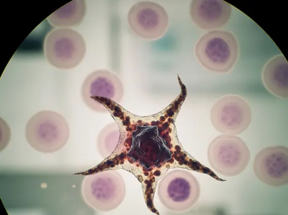 Survival Rate and Prognosis for Melanoma