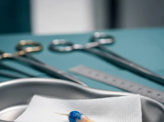 Sentinel Lymph Node Biopsy