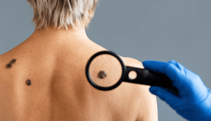melanotic sarcoma is a skin cancer that begins with: Six Questions to Ask If You Have Melanoma